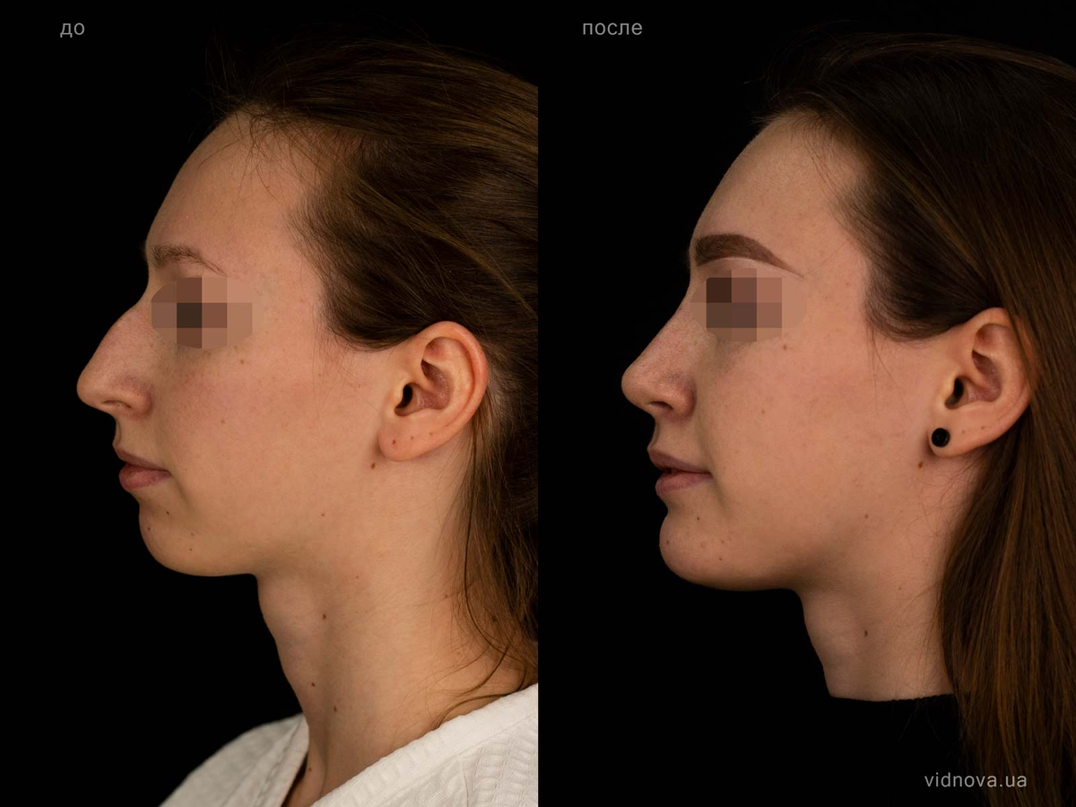 Фото НЕ моего пациента, я не делаю ментопластику.