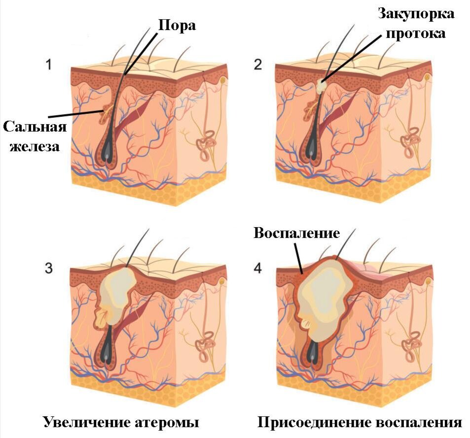 Атерома кожи (триходермальная киста)