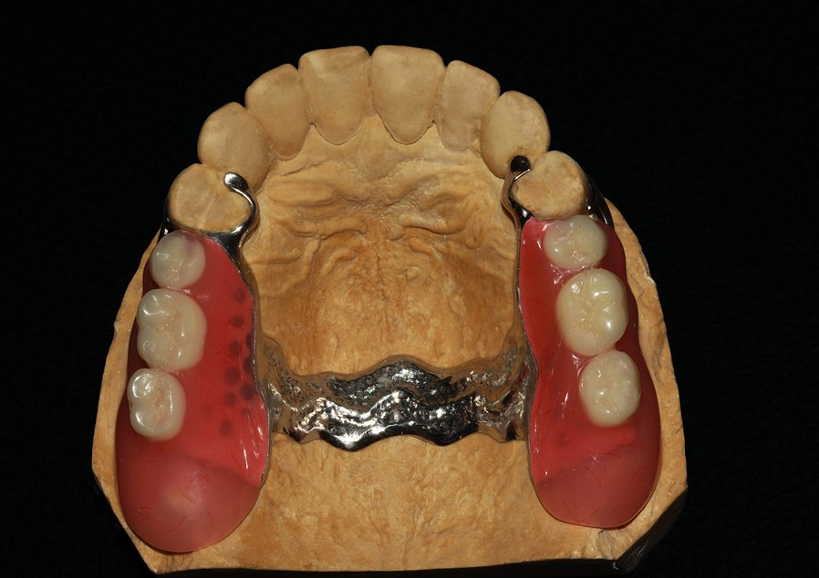 Протез на верхнюю челюсть фото. Бюгельный протез зубов на верхнюю челюсть. Бюгельный протез на Верхнем Селести. Бюгельный протез (1 челюсть)+кламмер. Бюгельный кламмерный протез верхней челюсти.
