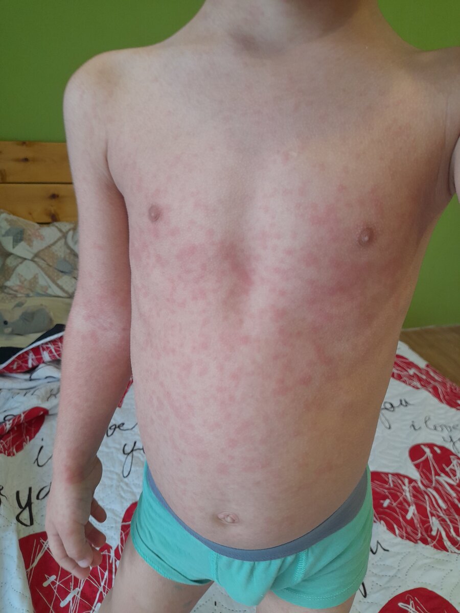 Началось высыпание. 