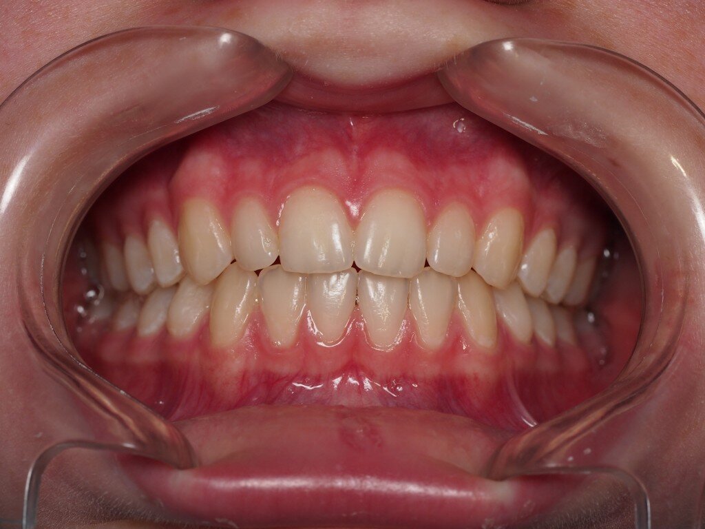 тут в прикусном снимке всё хорошо