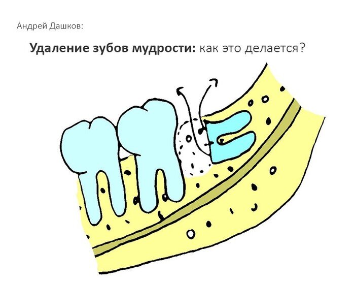 Уважаемые друзья, в прошлый раз мы с вами говорили о том, какие же бывают зубы мудрости, когда их нужно удалять, а когда нет. Чем чревато думать "не болит, значит все в порядке". А сегодня я подробно и во всех деталях расскажу, как непосредственно проходит удаление «приговорённых» зубов. С картинками. Поэтому рекомендую особо впечатлительным людям и беременным женщинам нажать сочетание клавиш «Ctrl +». Шутка.

