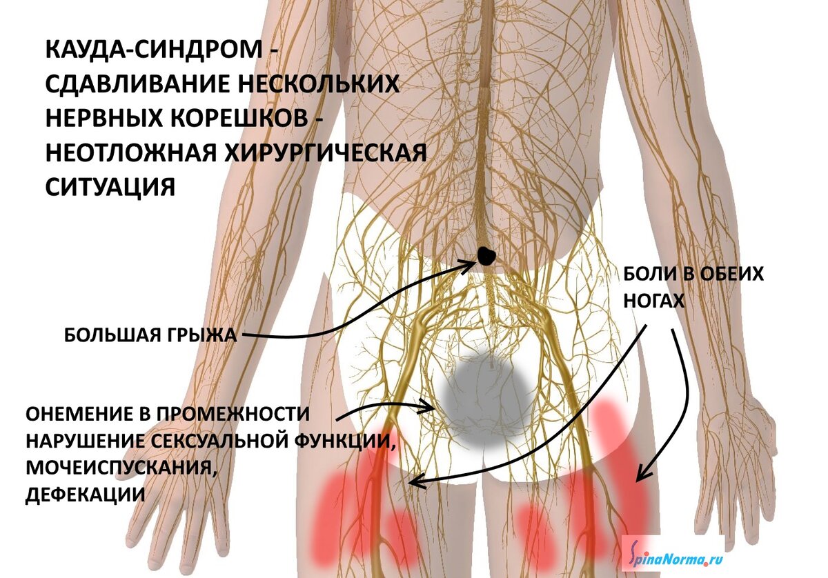 Клиническая картина компрессии корешков конского хвоста отличается от компрессии конуса и эпиконуса