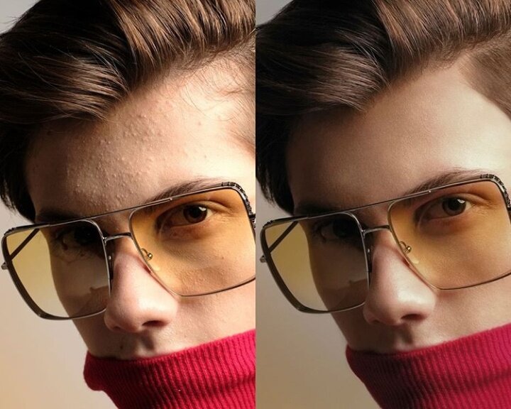 закрытые комедоны