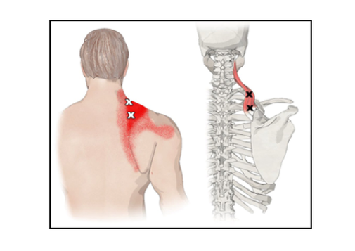 Крестиками обозначены болевые точки