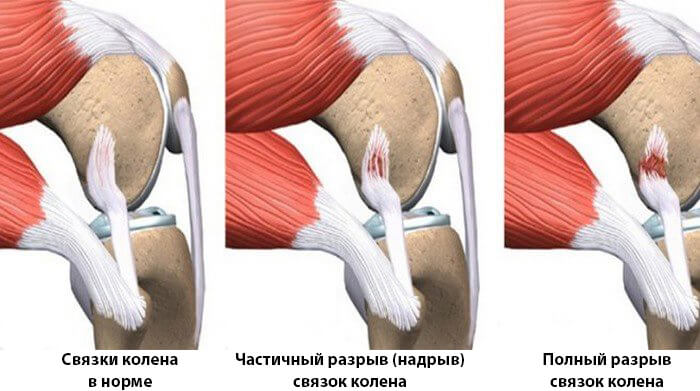 Укороченное сухожилие. Надрыв коленного сухожилия. Степени разрыва передней крестообразной связки. Разрыв связок коленного сустава. Надрыв связок коленного сустава.
