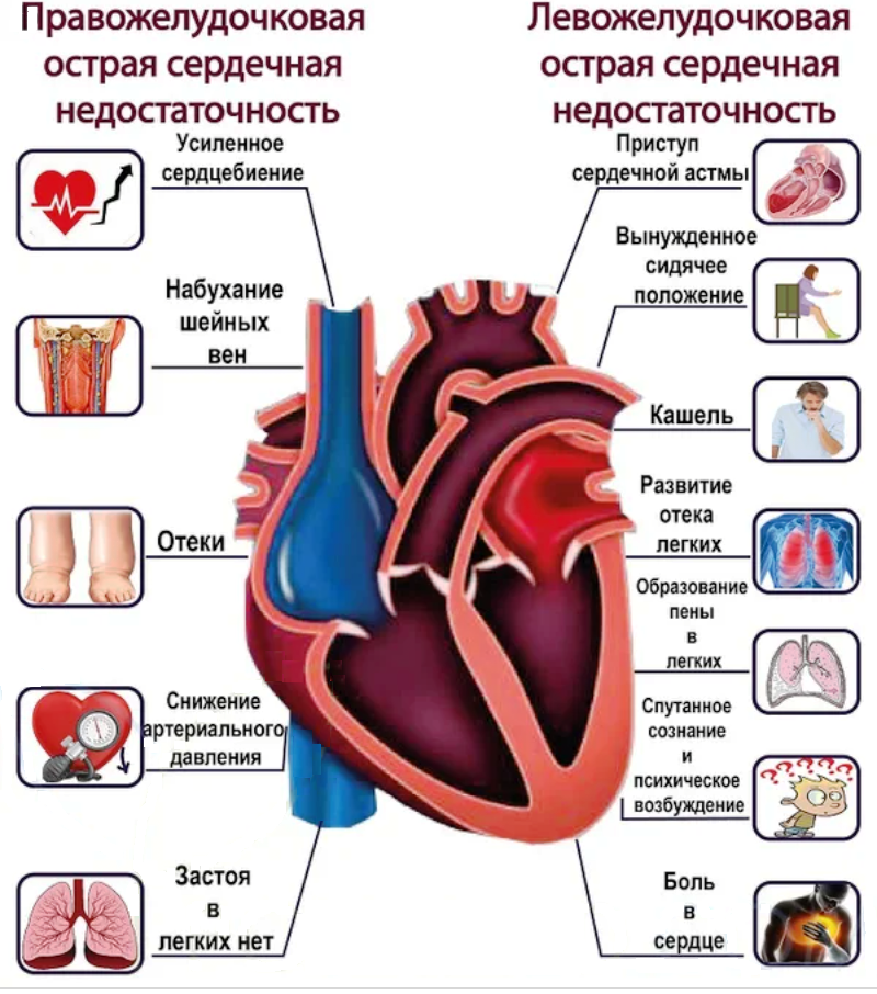 Почему сердечный. Проявления острой сердечной недостаточности. Острой сердечной и сосудистой недостаточности причины. Симптомы левосторонней сердечной недостаточности. Острая и хроническая сердечная недостаточность.