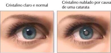 Слева хрусталик в норме, справа - хрусталик, затуманенный катарактой