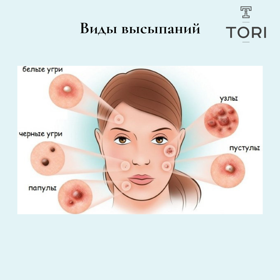 Говорящий прыщ. Пабулопастулезные высыпания.