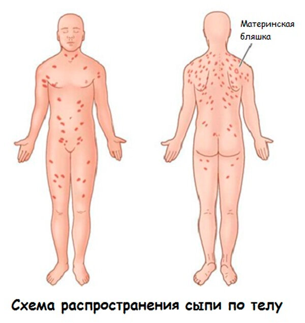 Розовый лишай: причины, симптомы и лечение