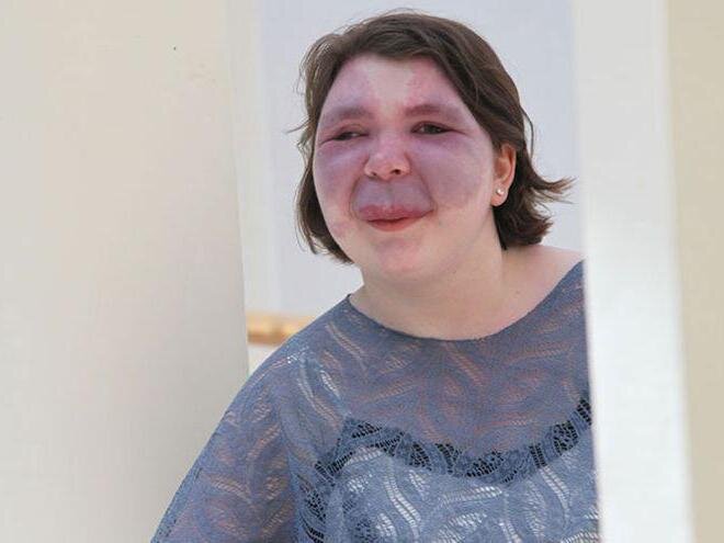 
Болезнь Вебера имеет следующие разновидности: