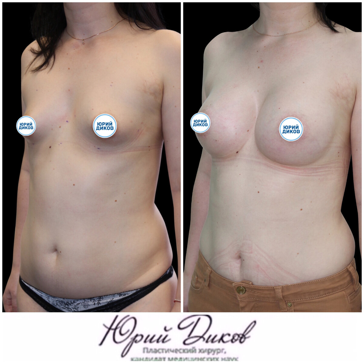 тубулярная деформация груди у женщин фото 18
