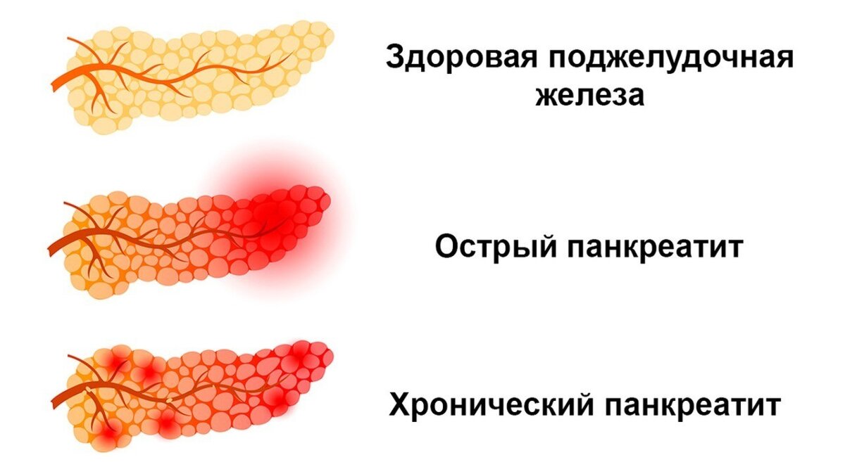 Панкреатит картинки для презентации