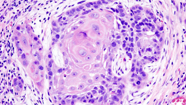 Раковые клетки в образце ткани из ротовой полости. Изображение © Wikimedia Commons / KGH