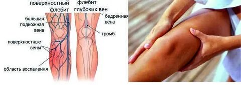 Флебит нижних конечностей симптомы фото и лечение Почему болят ноги? Флеболог. Хирург. Гирич Юрий. Новосибирск Дзен