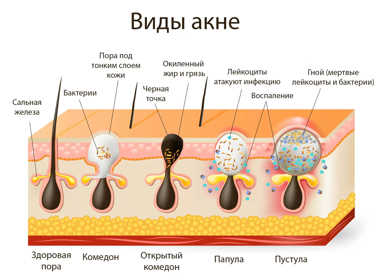 Виды прыщей на теле у женщины схема и описание