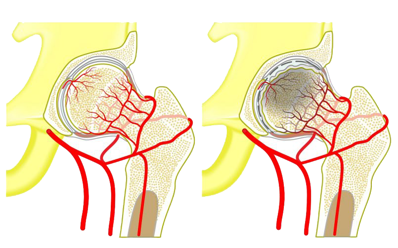 Слева - нормальный тазобедренный сустав и сосуды, обеспечивающие его кровью. Справа - схематичное изображение асептического некроза.