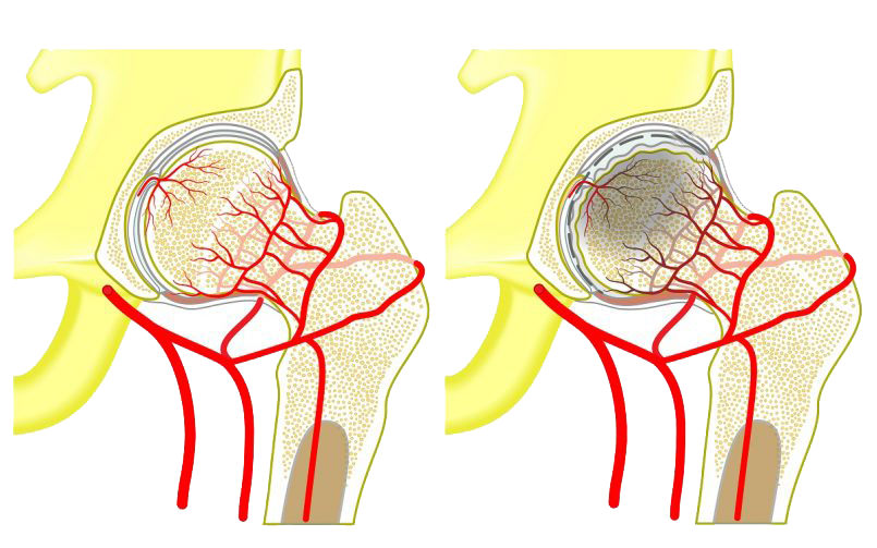 Асептический некроз головки бедренной кости - лечение в Запорожье | ЗОКБ