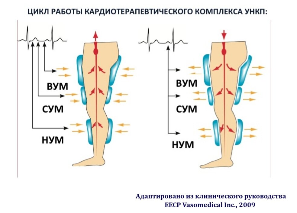 Усиленная наружная контрпульсация  (адаптировано из клинического руководства Vasomedical Inc.): слева на рис. – секвенциальная подача воздуха в манжеты в начале диастолы сердца; справа – одновременный спуск воздуха из манжеты перед очередной систолой сердца. ВУМ – верхний, СУМ- средний, НУМ – нижний уровень манжет.