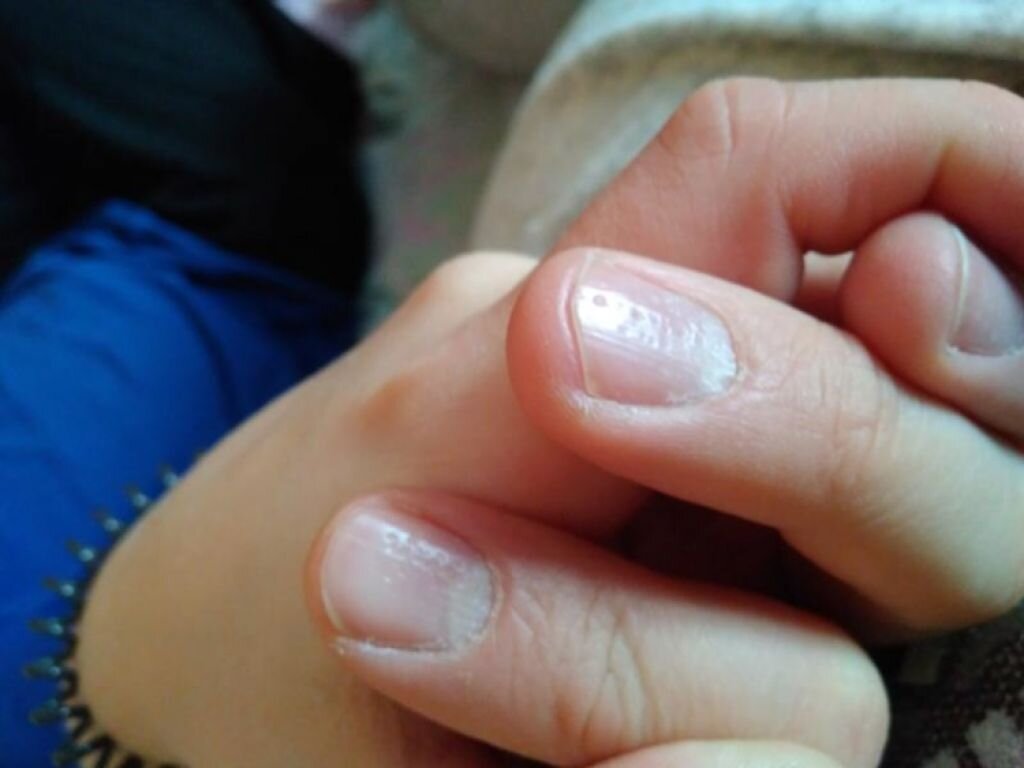 Почему ноготь маленький. Мелкие углубления на ногтях.