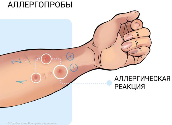 Аллергопроба как делают