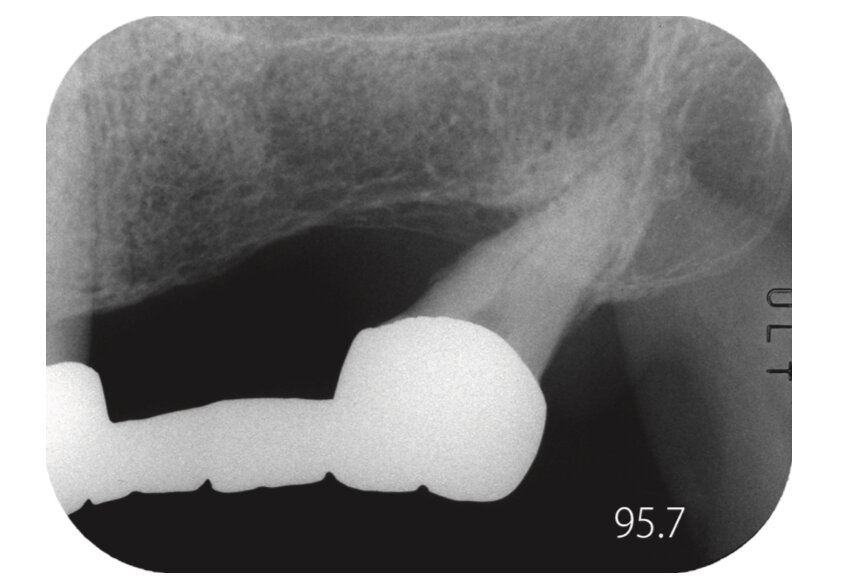 Рис. 1. Что мы можем определить по одной рентгенограмме? (Мужчина, 48 лет)