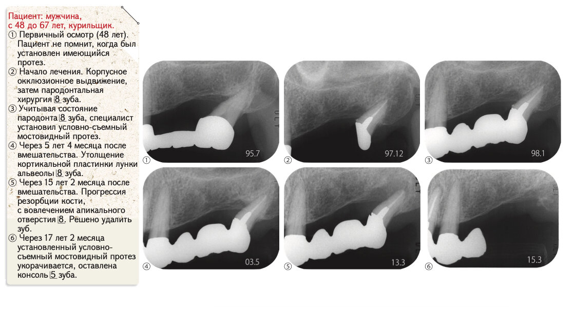 Рис. 2. Условно-съемный мостовидный протез, установленный в данном случае