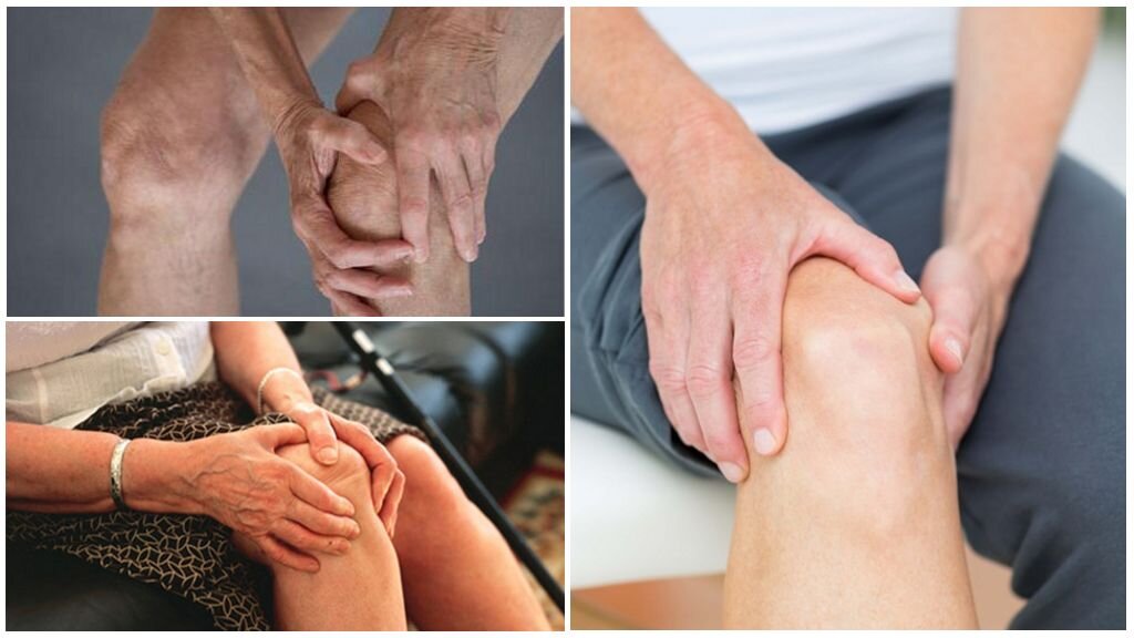 Эффективное лечение артроза сустава. Артрит и артроз артралгия. Ревматоидный артроз коленного сустава.