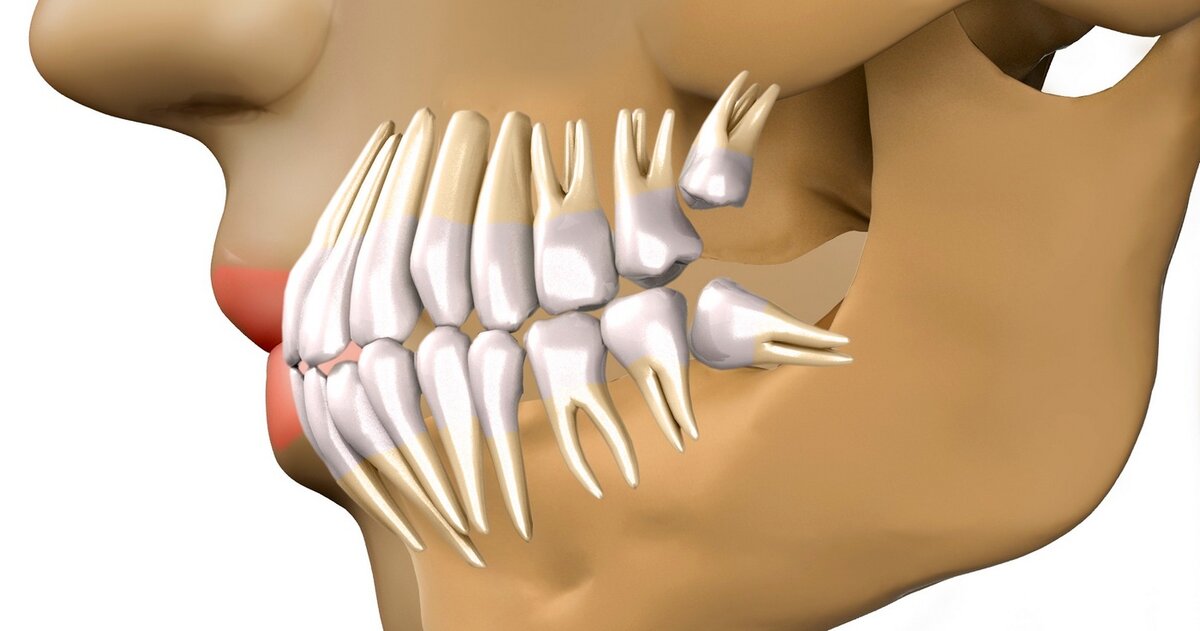Зубы мудрости. Интересные факты