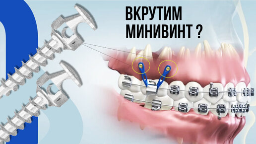 Минивинты‼️Почему в 82% клинических случаев ортодонты их применяют ...