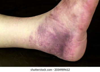 Синяк и опухоль.