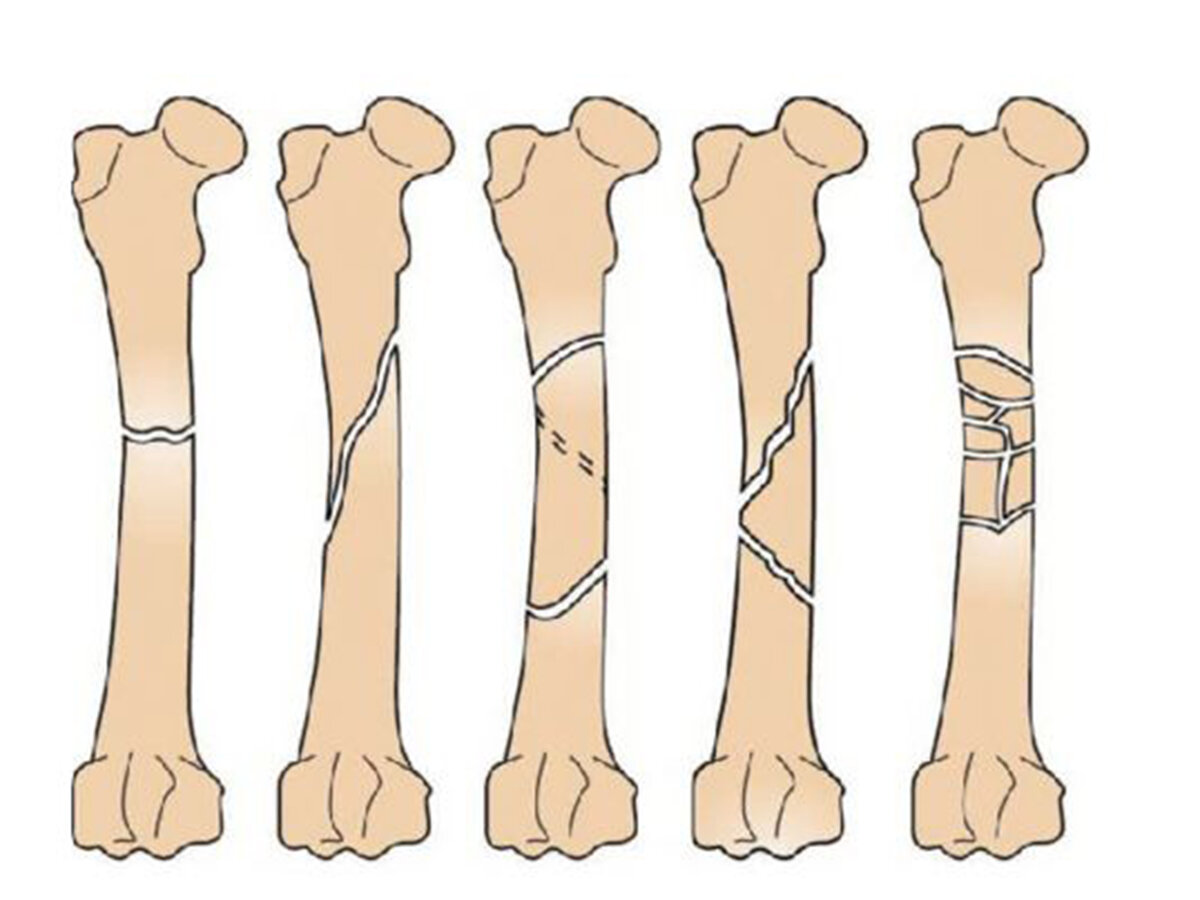 Перелом картинки. Диафизарные переломы бедренной кости. Бедренная кость перелом диафиза. Перелом с/3 диафиза бедренной кости. Диафизарные переломы бедренной кости классификация.