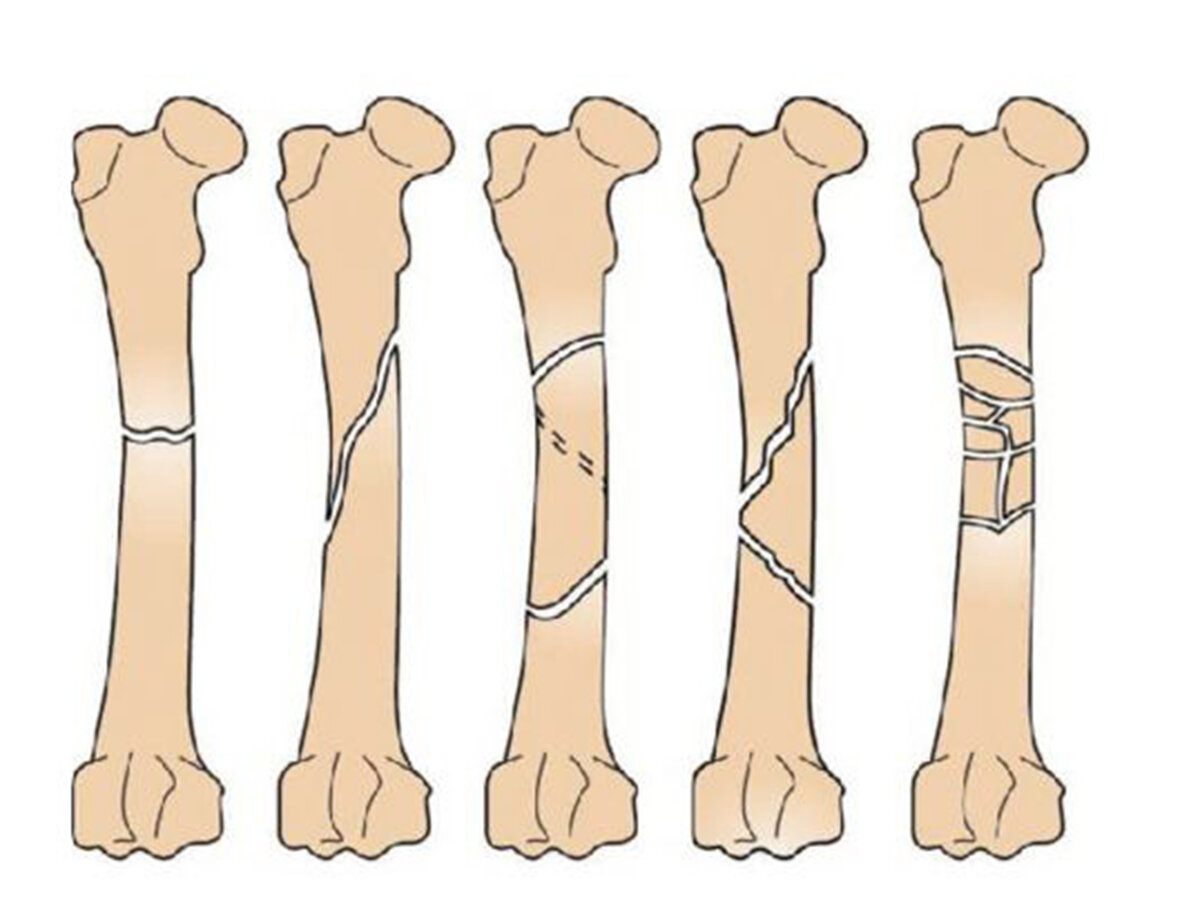 Повреждение бедренной кости. Диафизарные переломы бедренной кости. Бедренная кость перелом диафиза. Перелом с/3 диафиза бедренной кости. Диафизарные переломы бедренной кости классификация.