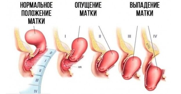 Операции для коррекции опущения и выпадения стенок влагалища и матки