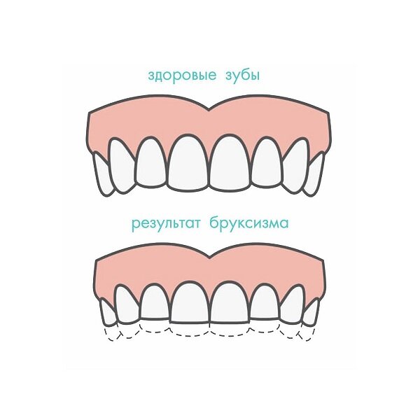 Фото с сайта https://orbital-dent.ru/blog/bruksizm/