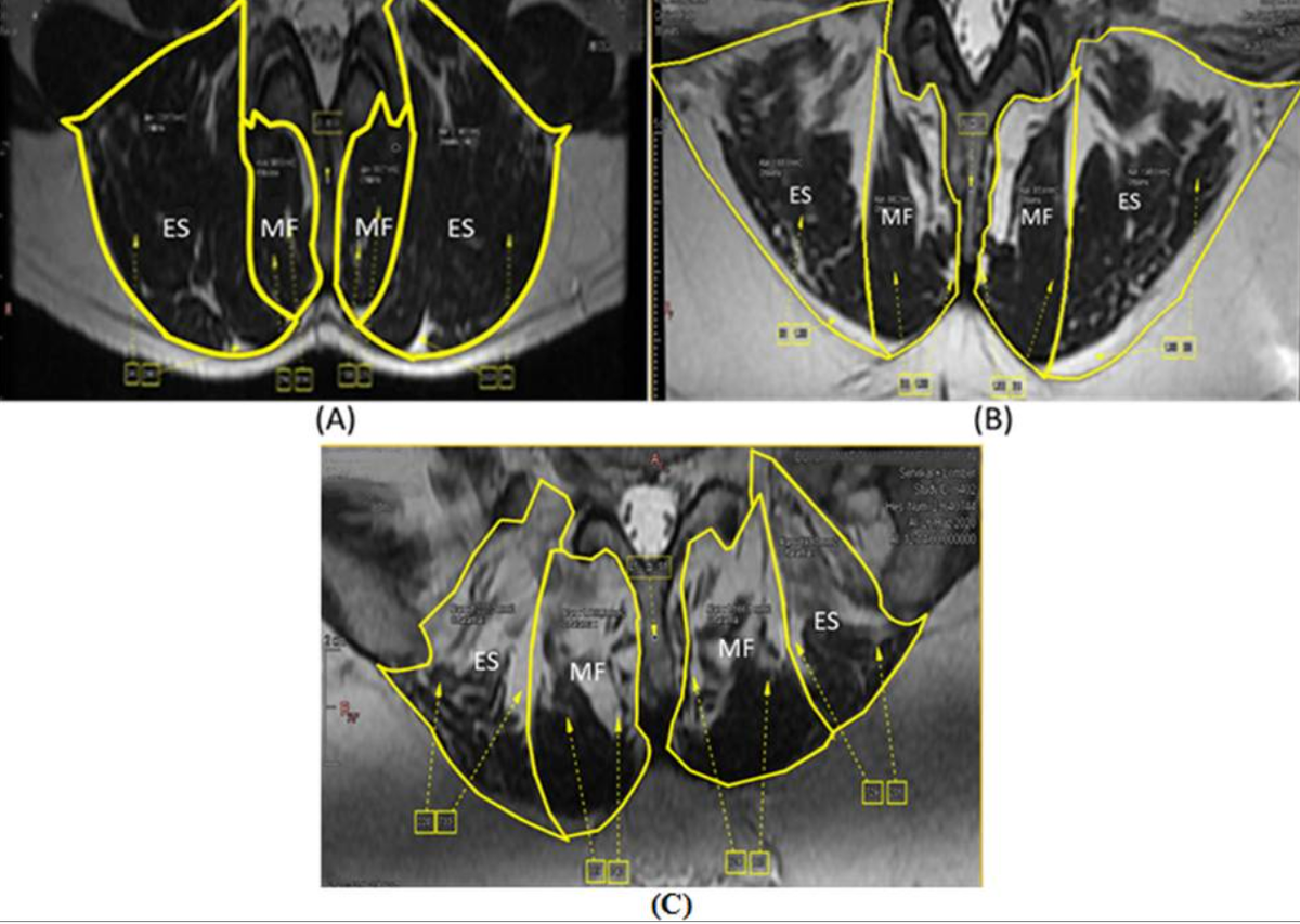 Степени жировой инфильтрации мышц по МРТ(желтым обведены мышцы, белые участки внутри - жировая дегенерация) A степень 1: жировая инфильтрация мышцы <10 %
B степень 2: жировая инфильтрация мышцы 10–50 %
C степень 3: жировая инфильтрация мышцы >50 %
MF - многораздельная мышца, ES - мышца, выпрямляющая позвоночник 
