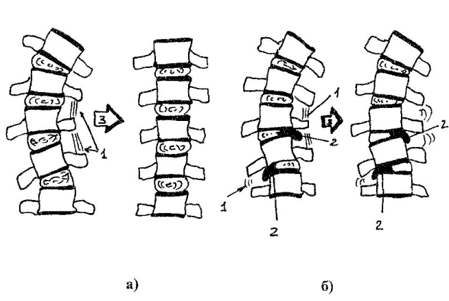 Из книги В.Г. Соломатов "Межпозвонковая грыжа от "А" до "Я"