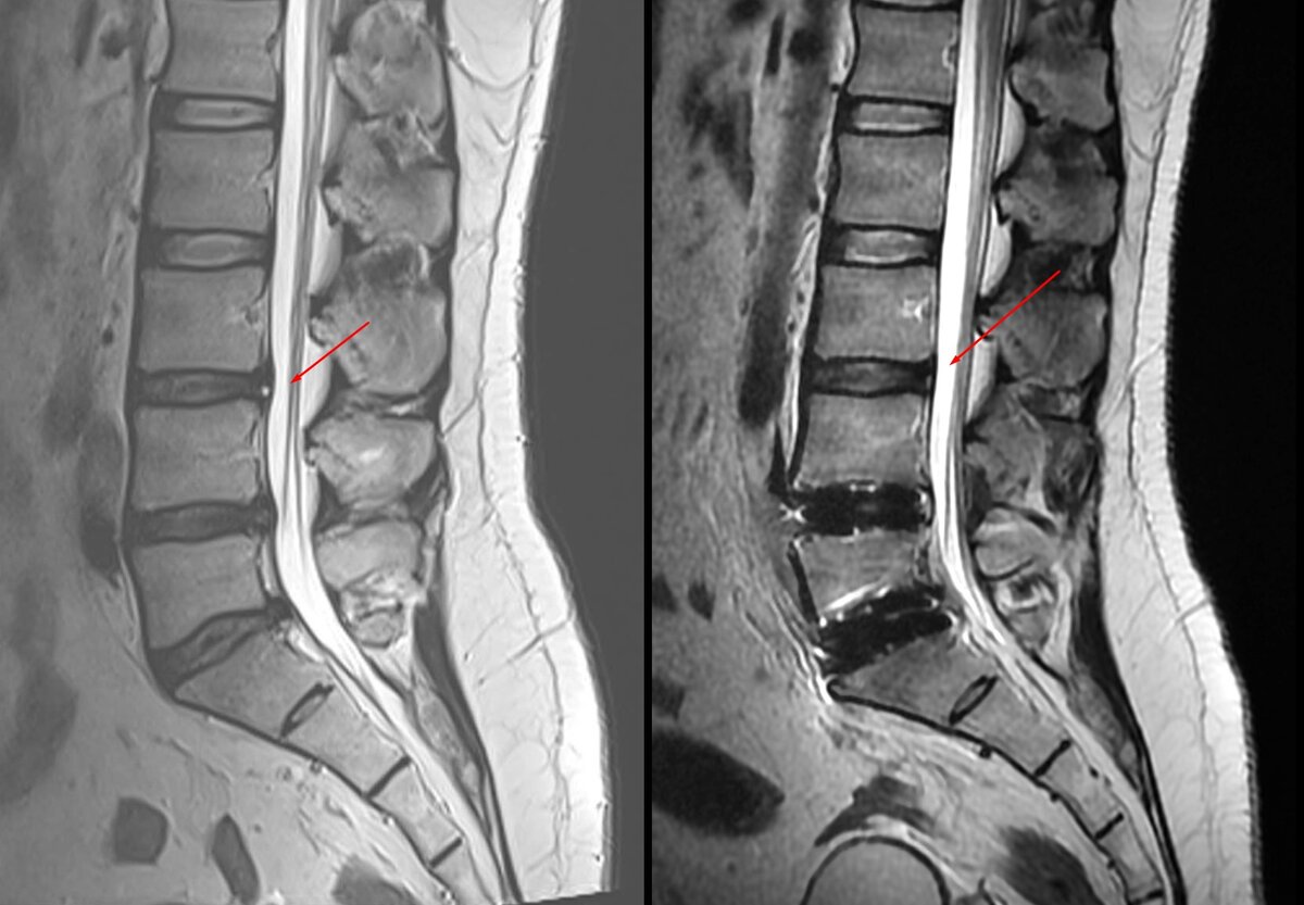 До и после операции, видно, как 3я грыжа сама уменьшилась в результате установки протезов M6-L. Видимо это связанно с тем, что расстояние между позвонками увеличилось, распределилась нагрузка. Хирург сразу сказал, ещё перед операцией, она сама уйдёт.