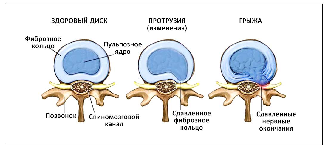 Фиброзное кольцо