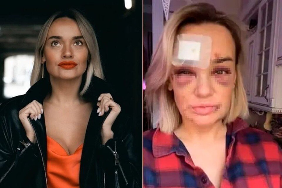     Девушка получила сотрясение мозга и контузию. Фото: СОЦСЕТИ