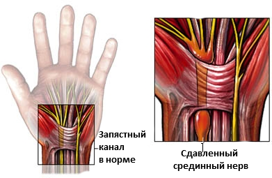 Туннельный синдром: причины возникновения, симптомы и лечение — интернет-портал Спортмастер Медиа