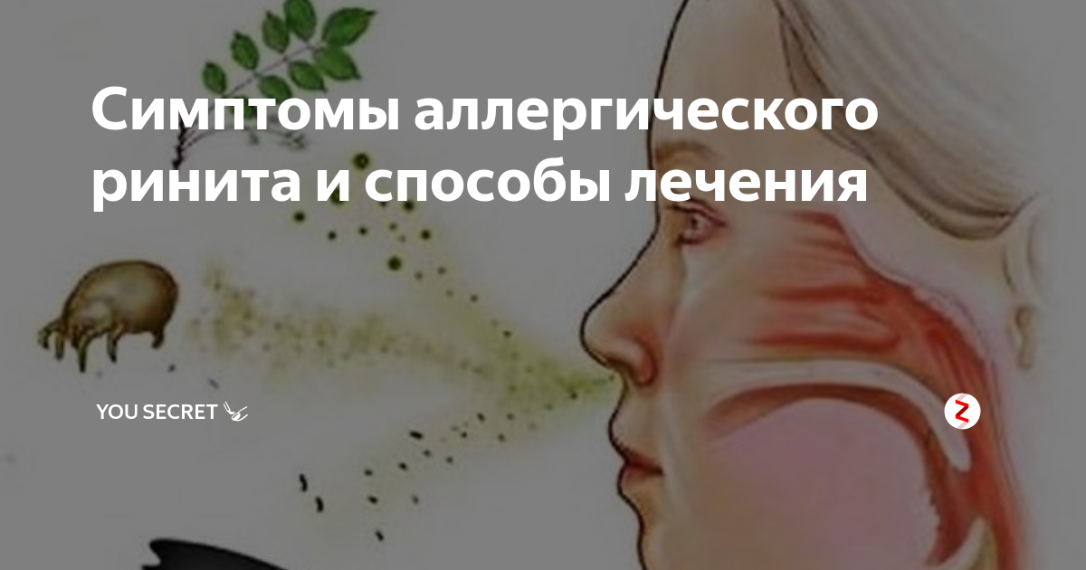Избавиться от ринита навсегда. Симптомы аллергического ринита. аллергический ринит синдромы. внешние признаки аллергического ринита. аллергический ринит июль-август.