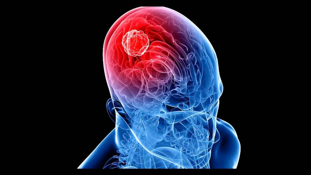  Рак головного мозга - серьезное заболевание, связанное с разрастанием злокачественной опухоли в головном мозге.