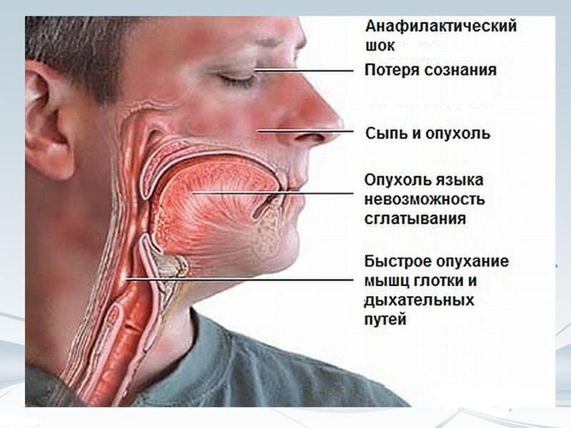 Что делать, если человек подавился и задыхается: первая помощь при удушье