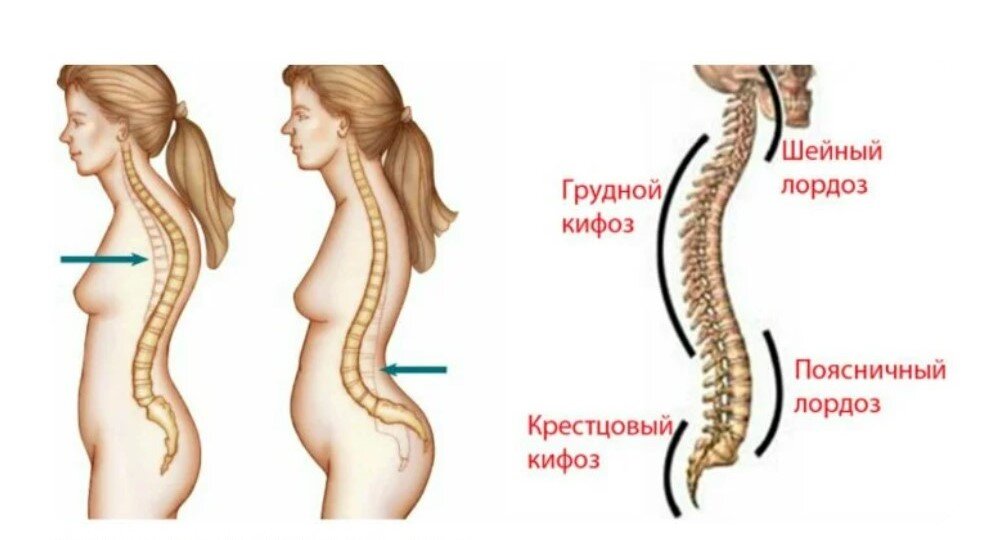 Что такое кифоз. Шейный лордоз и кифоз. Лордоз и кифоз шейного отдела. Кифоз грудного отдела и лордоз поясничного отдела. Лордоз позвоночника сглажен.