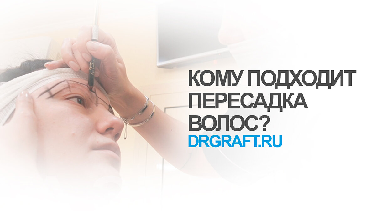 Кому подходит пересадка волос? 