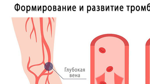 Важное про Тромбы. Все что нужно знать о тромбах и как себе помочь!