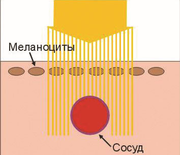 Схема лазерного воздействия на сосуд