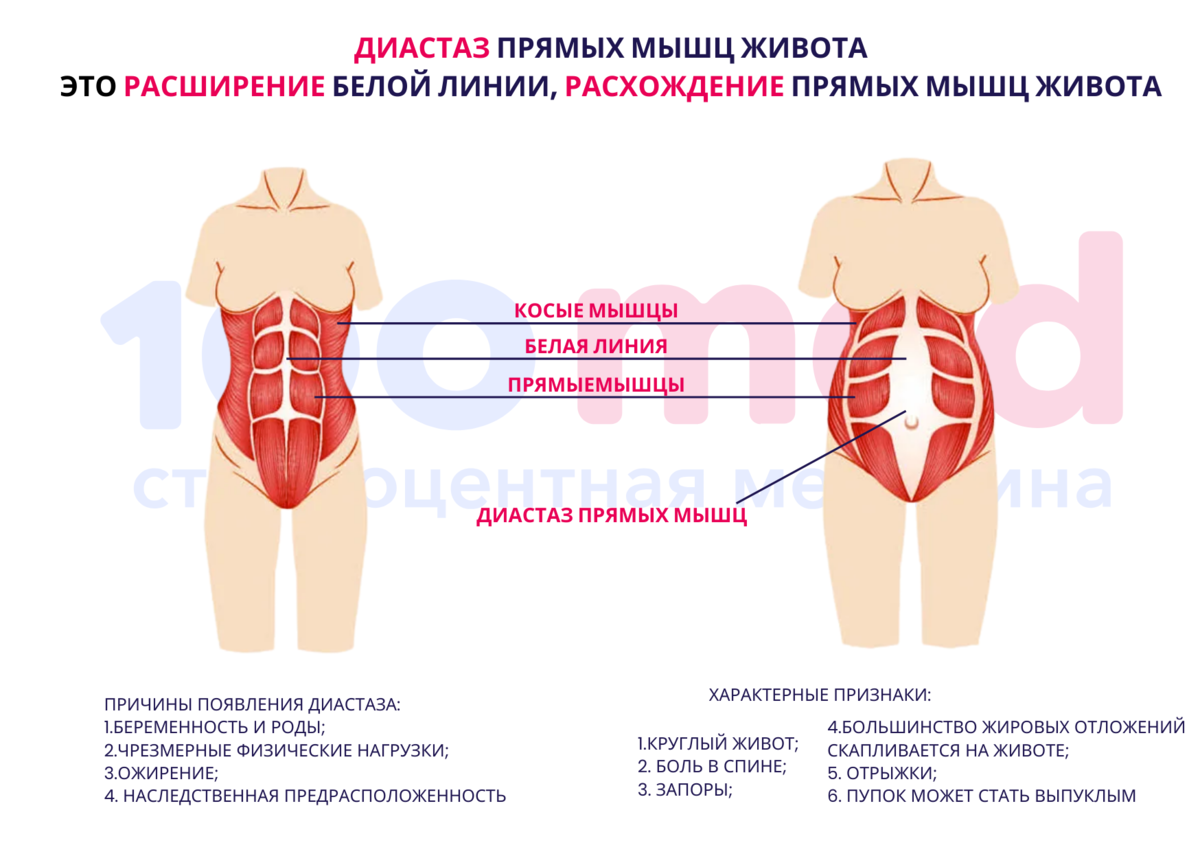 Диастаз прямых мышц живота. Расхождение мышц живота. Расхождение прямых мышц живота. Типы диастаза прямых мышц живота.