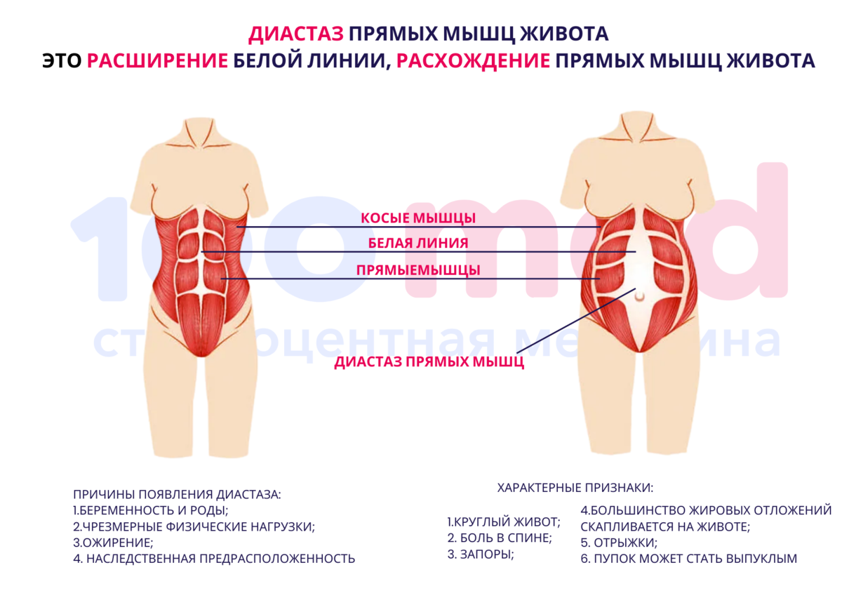 Болят мышцы живота причины. Диастаз прямых мышц живота. Расхождение мышц живота. Расхождение прямых мышц живота. Типы диастаза прямых мышц живота.